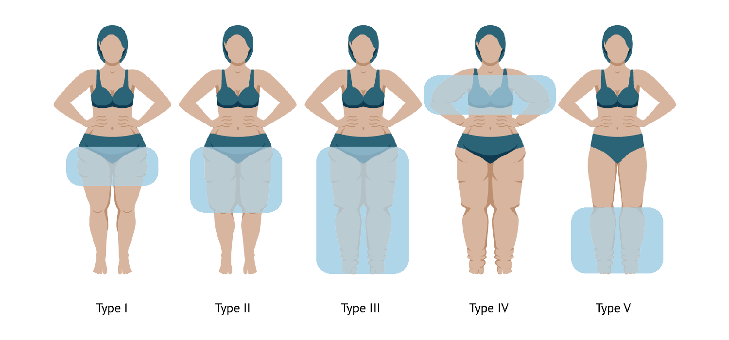 Types of Lipedema