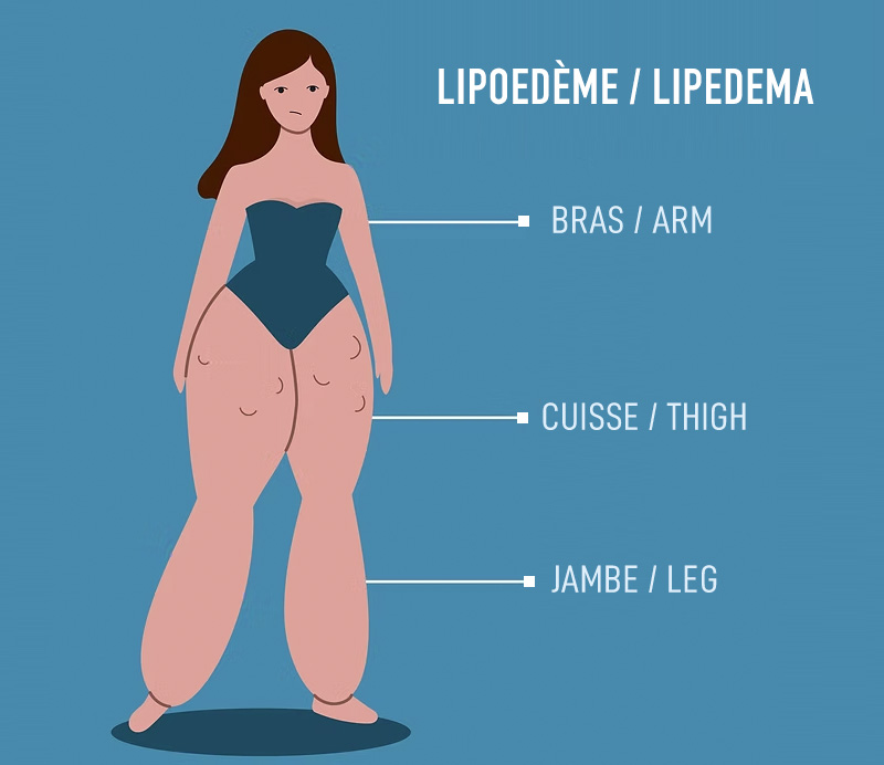 Lipoedeme-Lipedema-Montreal-Canada