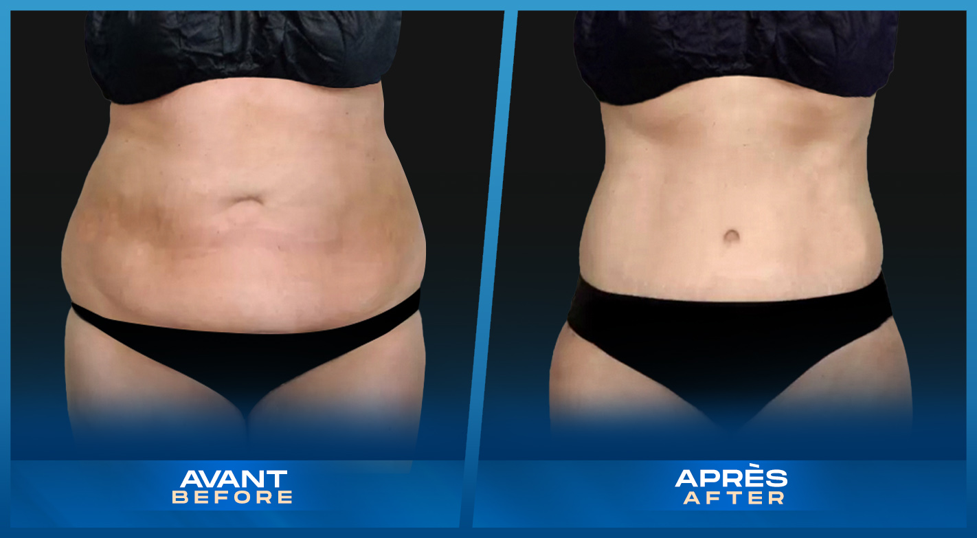 Tummy Tuck (Abdominoplastie) Montreal, Quebec