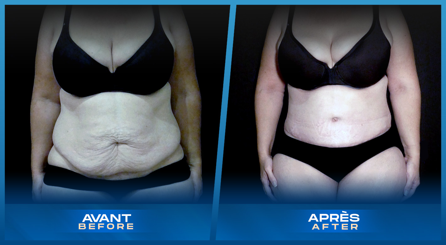 Tummy Tuck (Abdominoplastyie) Montreal, Quebec