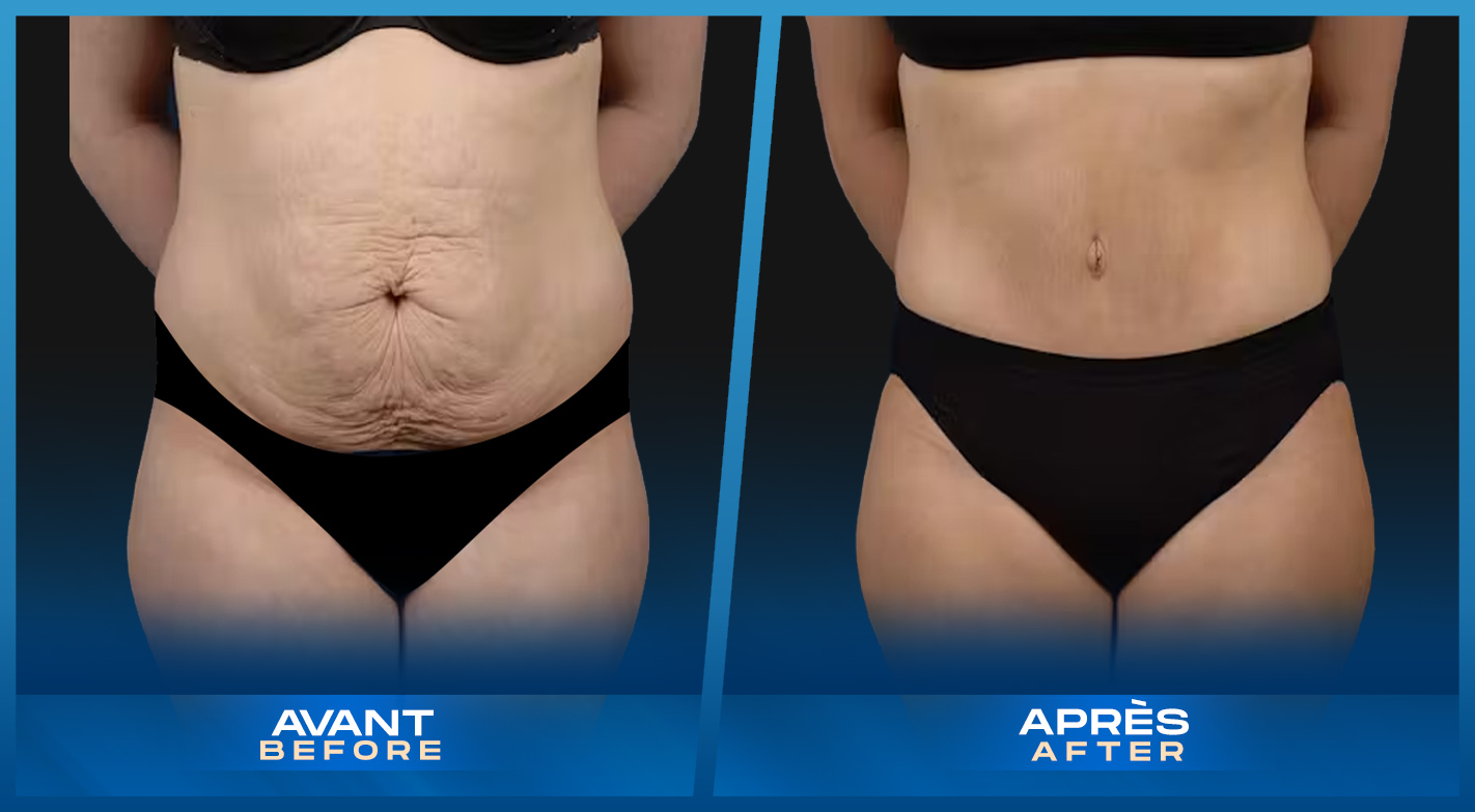 Tummy Tuck (Abdominoplastie) Montreal, Quebec