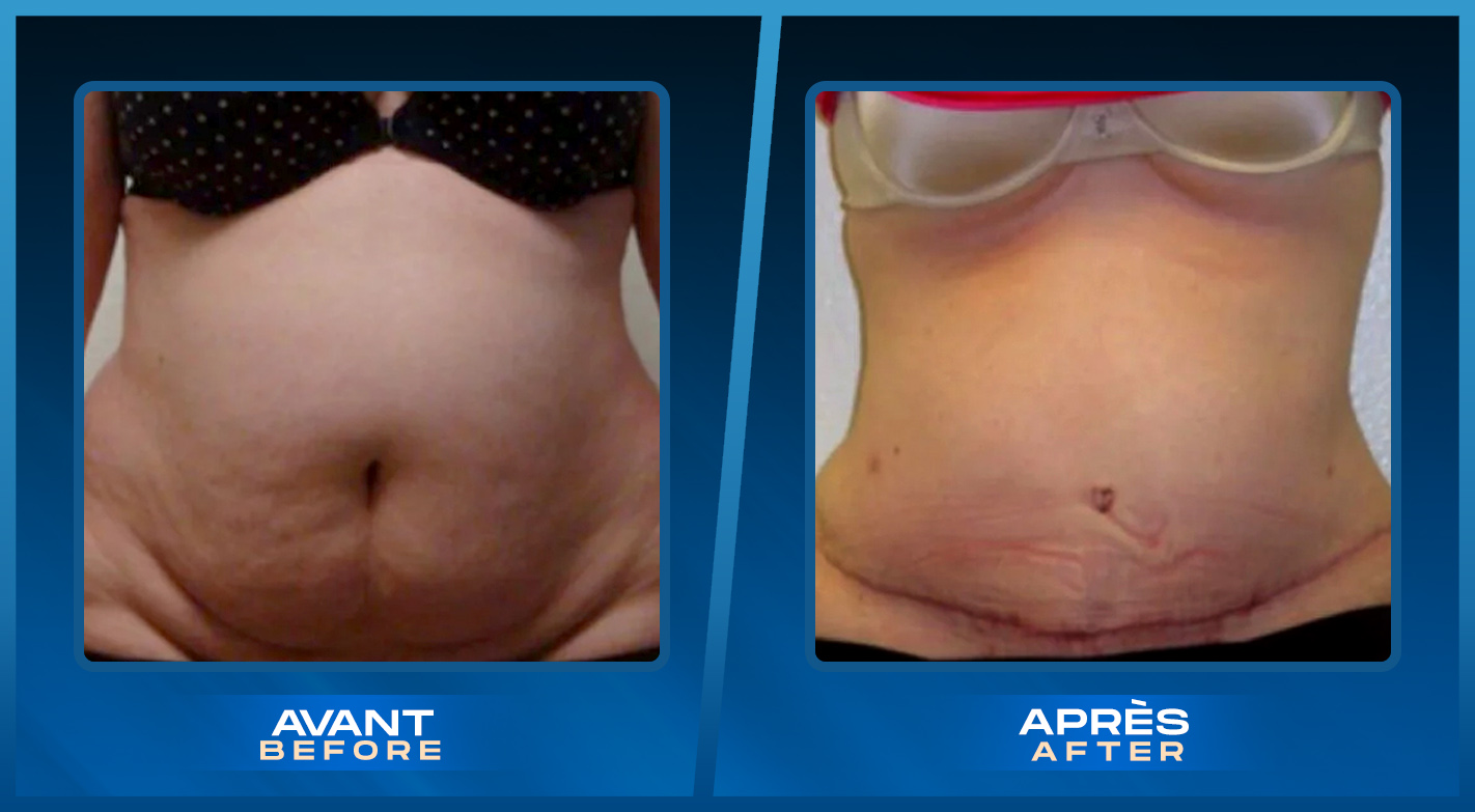 Tummy Tuck (Abdominoplastie) Montreal, Quebec