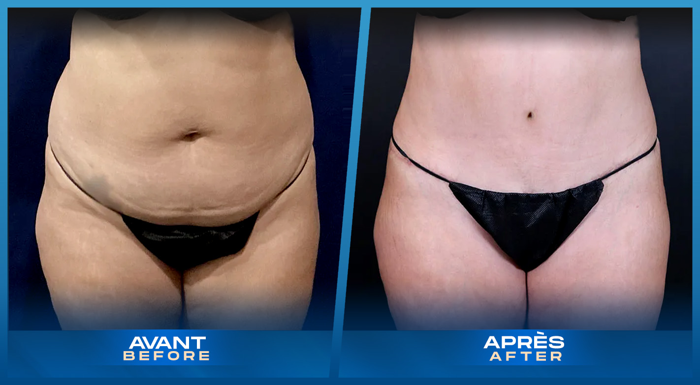 Tummy Tuck (Abdominoplastie) Montreal, Quebec