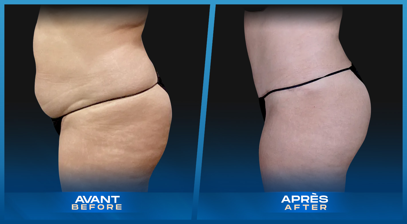 Tummy Tuck (Abdominoplastie) Montreal, Quebec