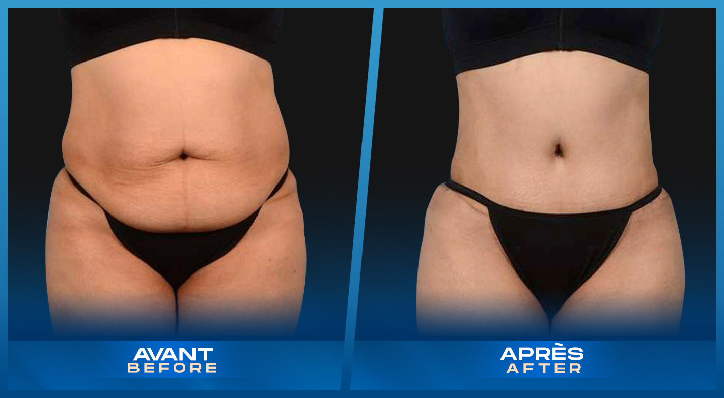Tummy Tuck (Abdominoplastie) Montreal, Quebec