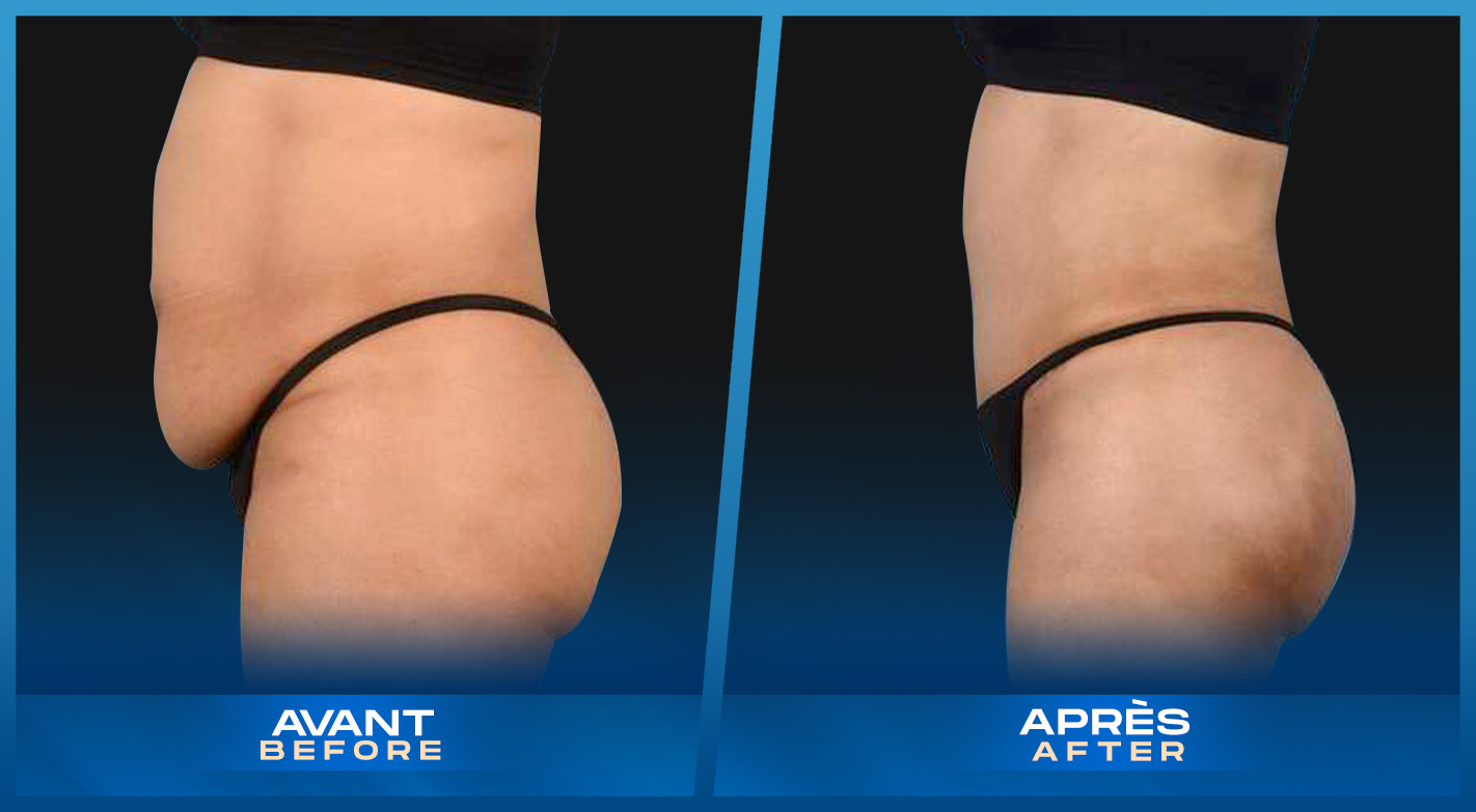 Tummy Tuck (Abdominoplastie) Montreal, Quebec