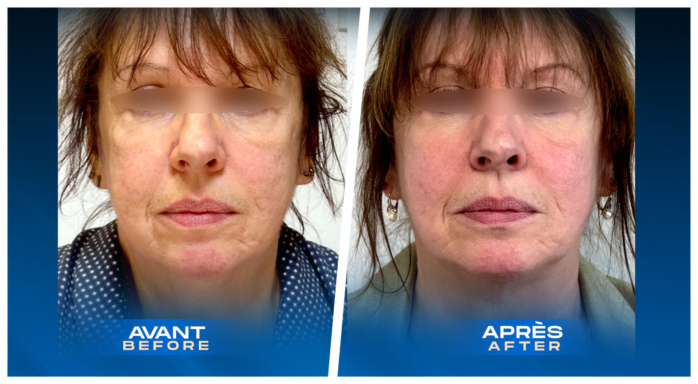 Facial Fat Transfer (fat grafting) in Montreal, Quebec