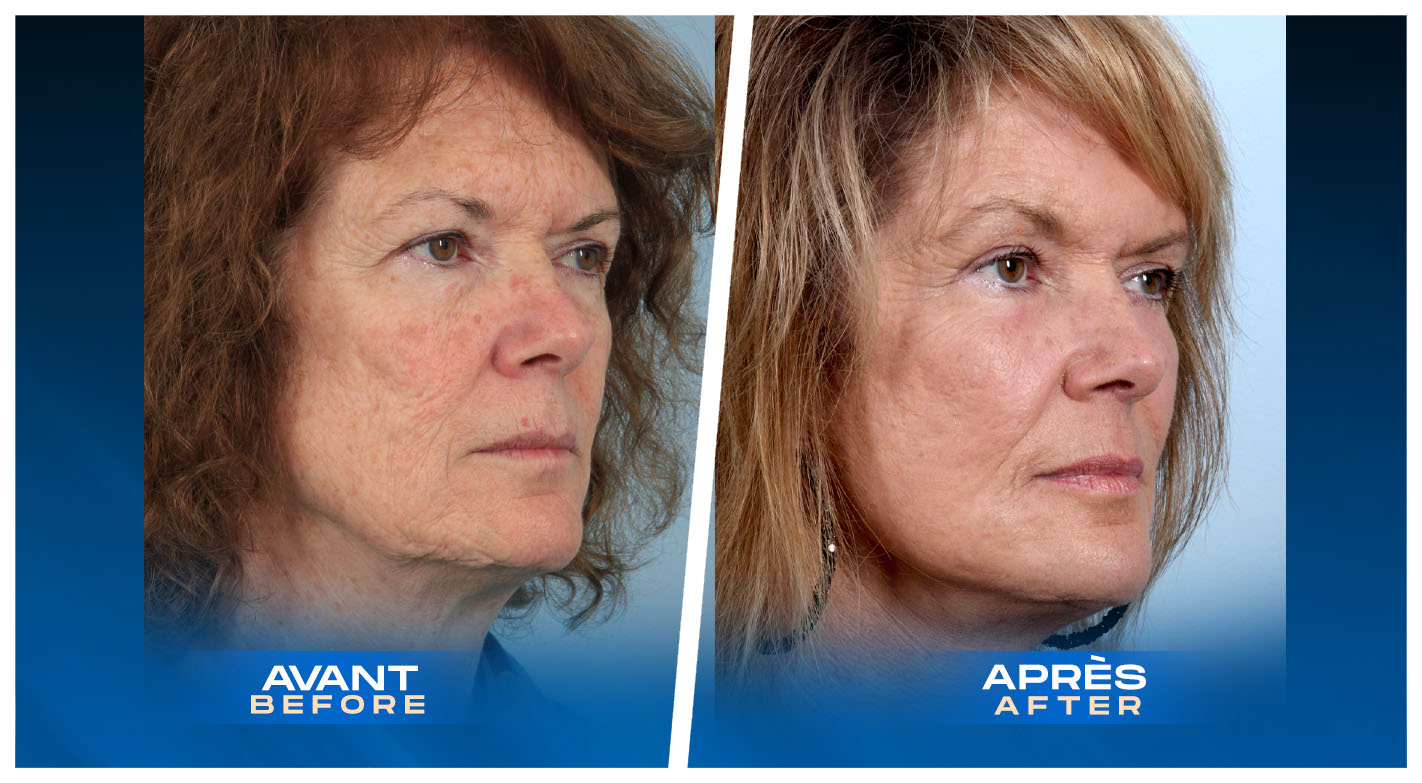 Facial Fat Transfer (fat grafting) in Montreal, Quebec