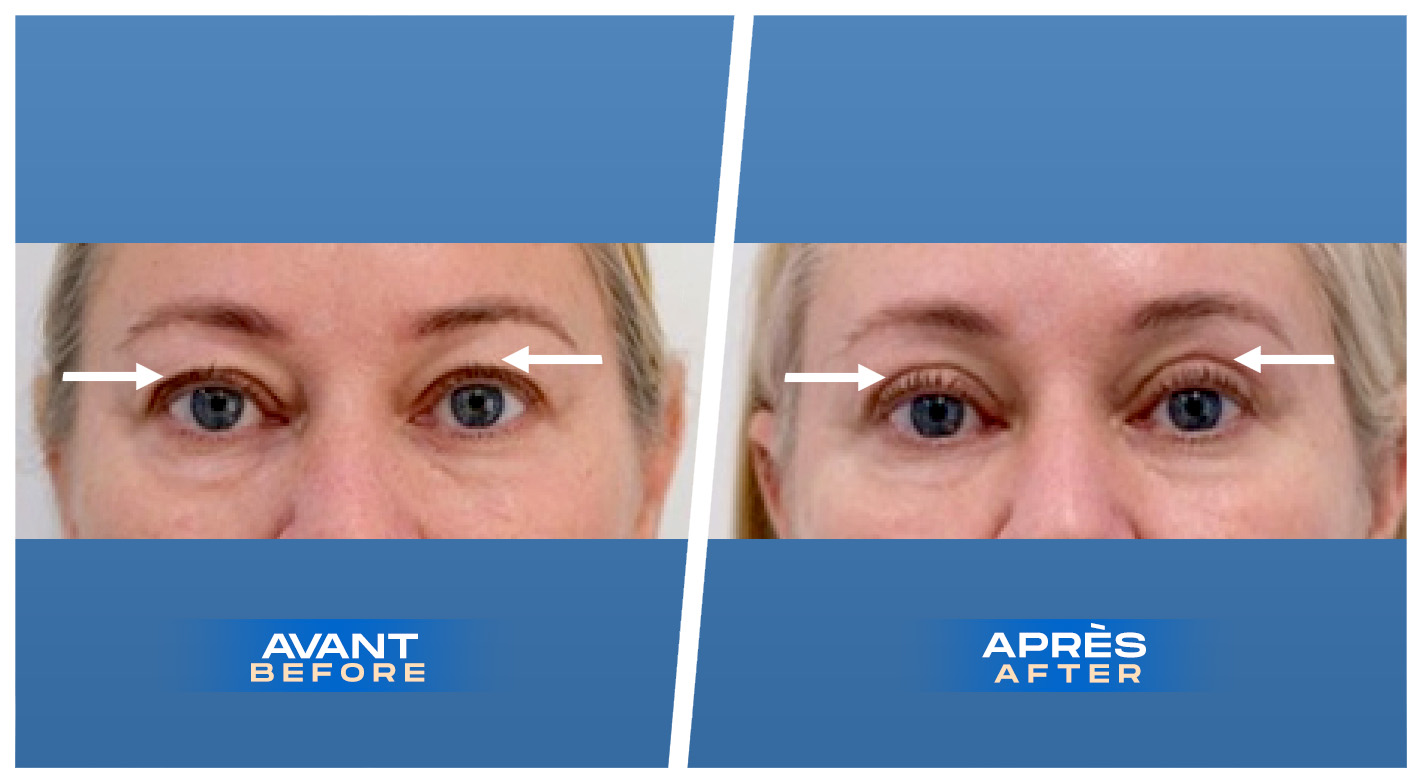 Blépharoplastie des paupières supérieures à Montréal, Québec