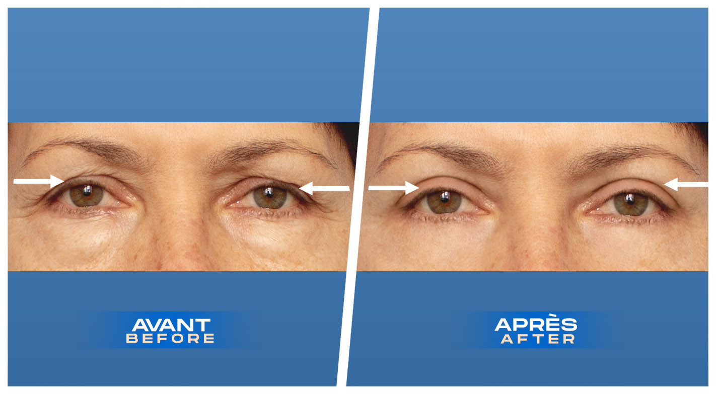 Blépharoplastie des paupières supérieures à Montréal, Québec