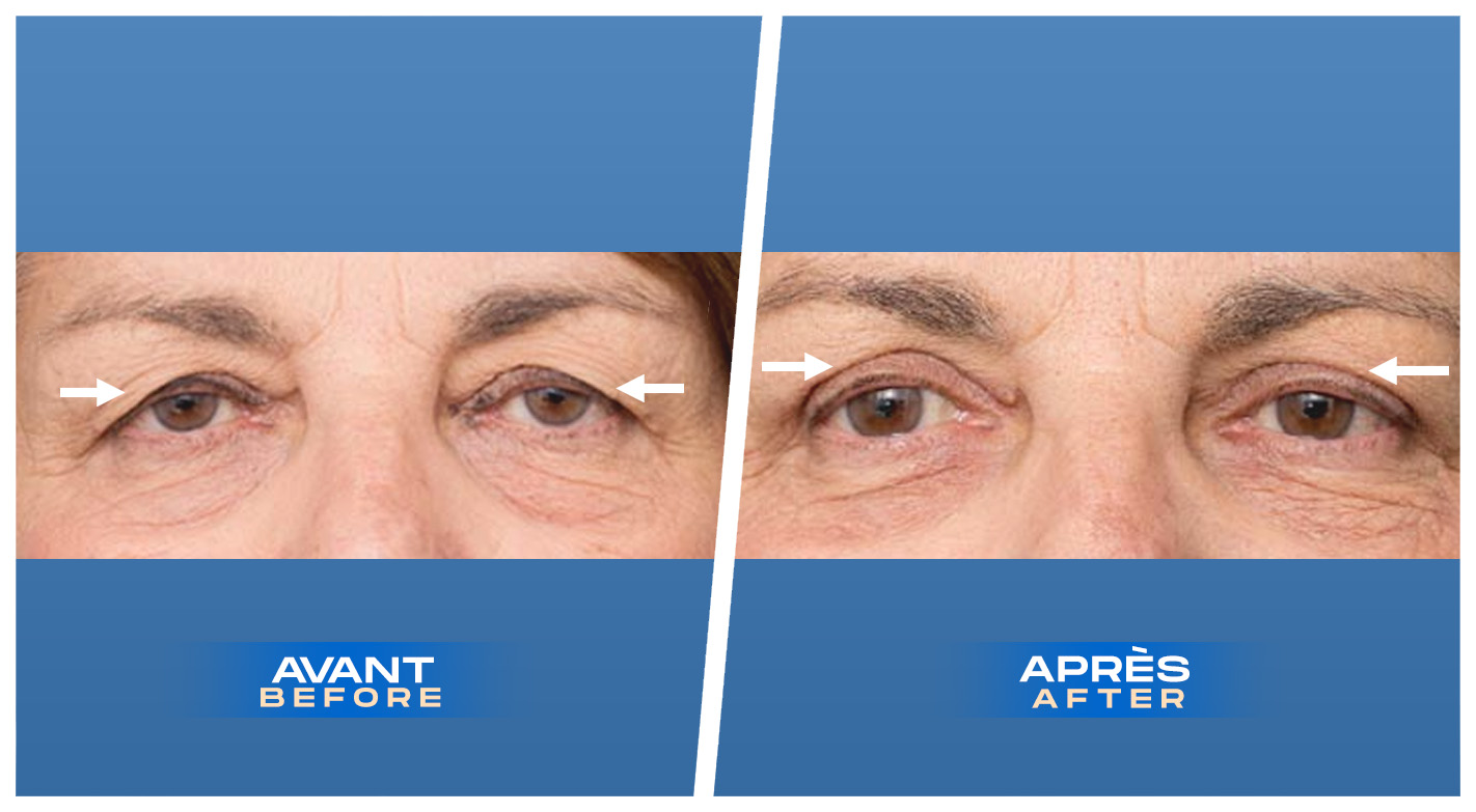 Blépharoplastie des paupières supérieures à Montréal, Québec