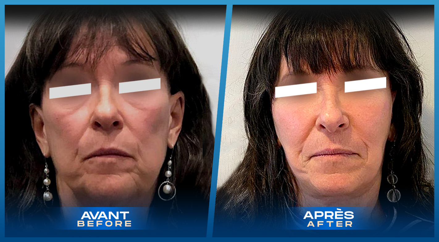 Facelift Montreal