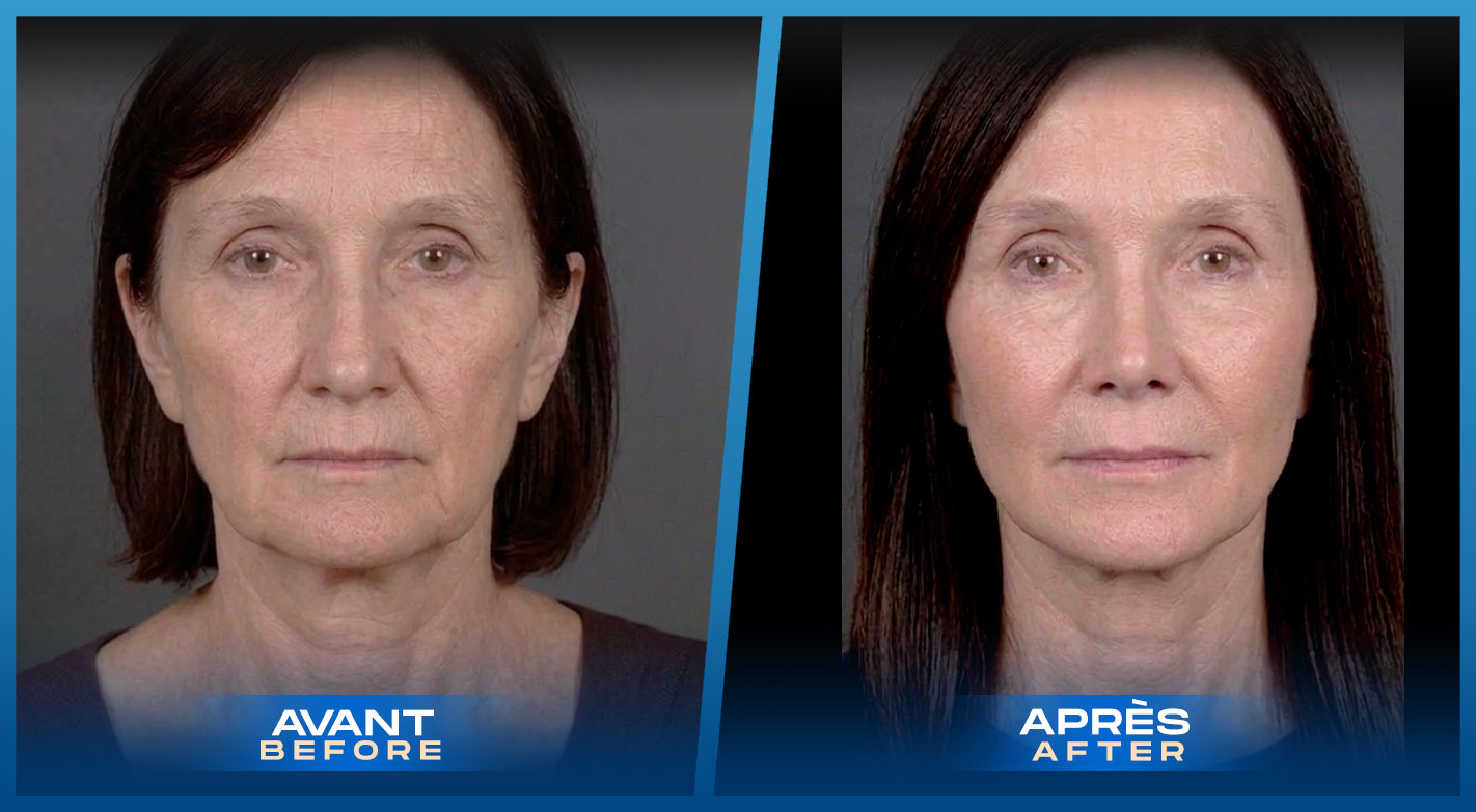 Facelift Montreal