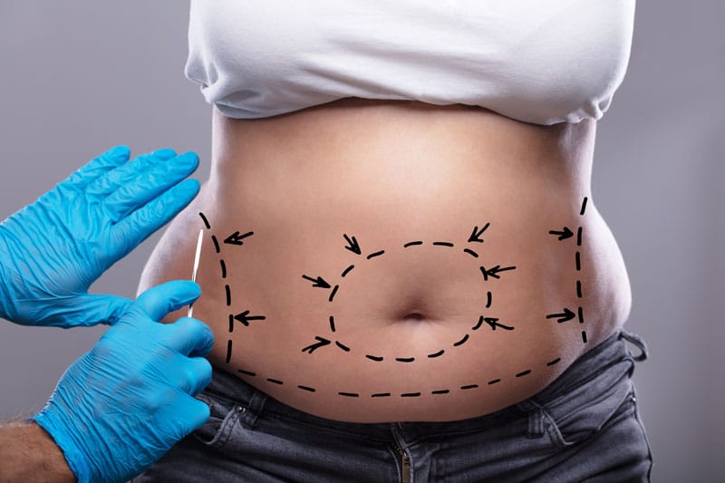 tummy tuck is a surgical procedure in Montreal.