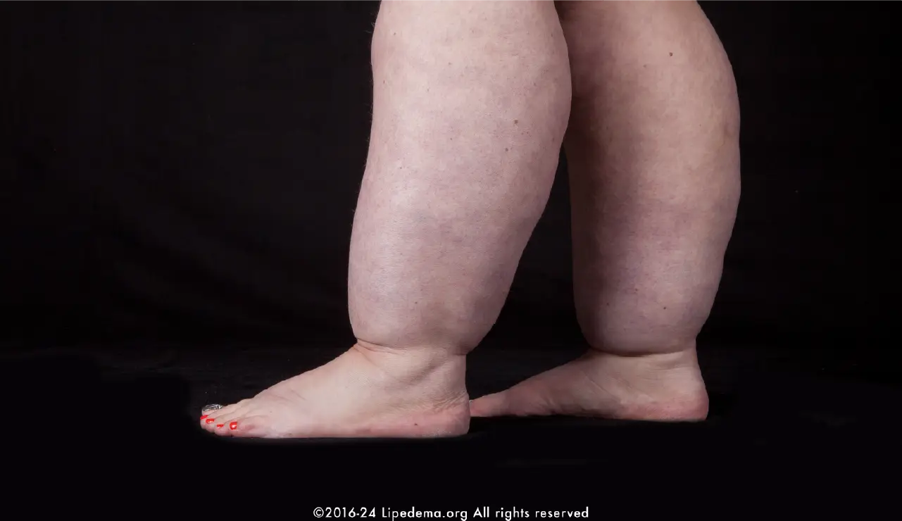 Treatment for Lipedema in Montreal, Quebec