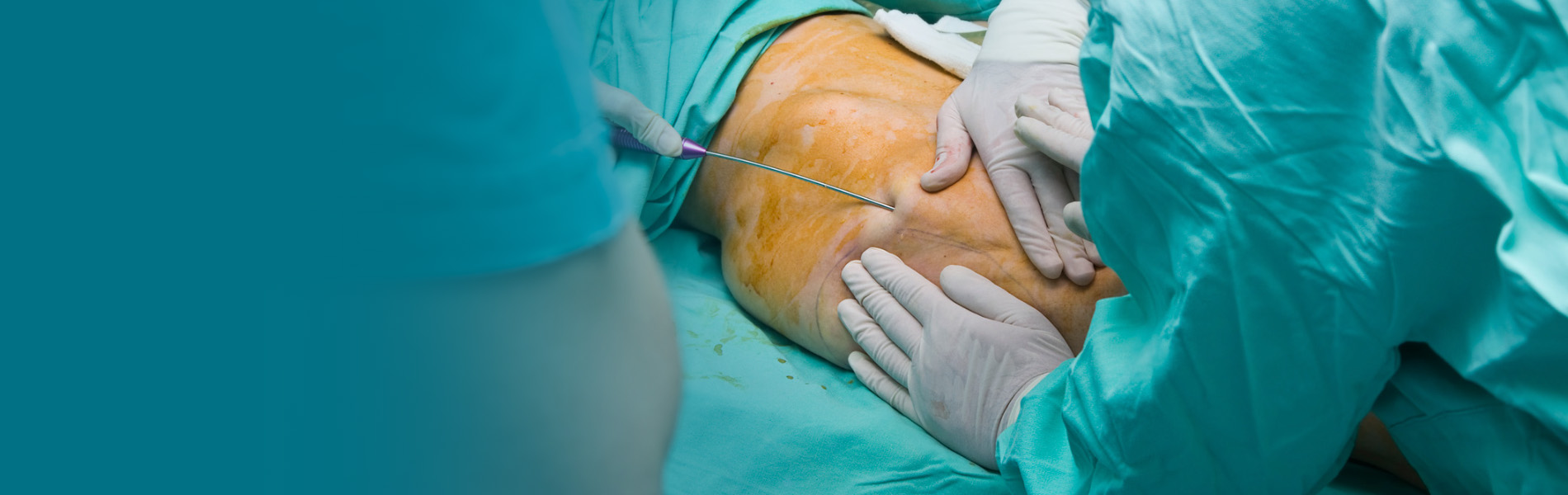 Causes, Symptoms & Treatment of Lipedema
