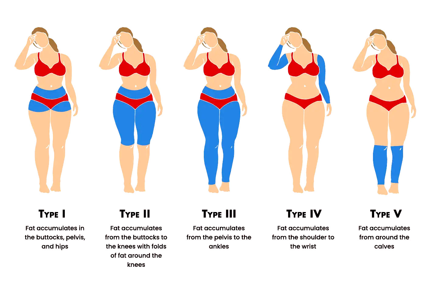 Understanding Lipedema