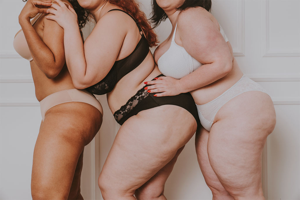 Lipedema Surgery in Montreal