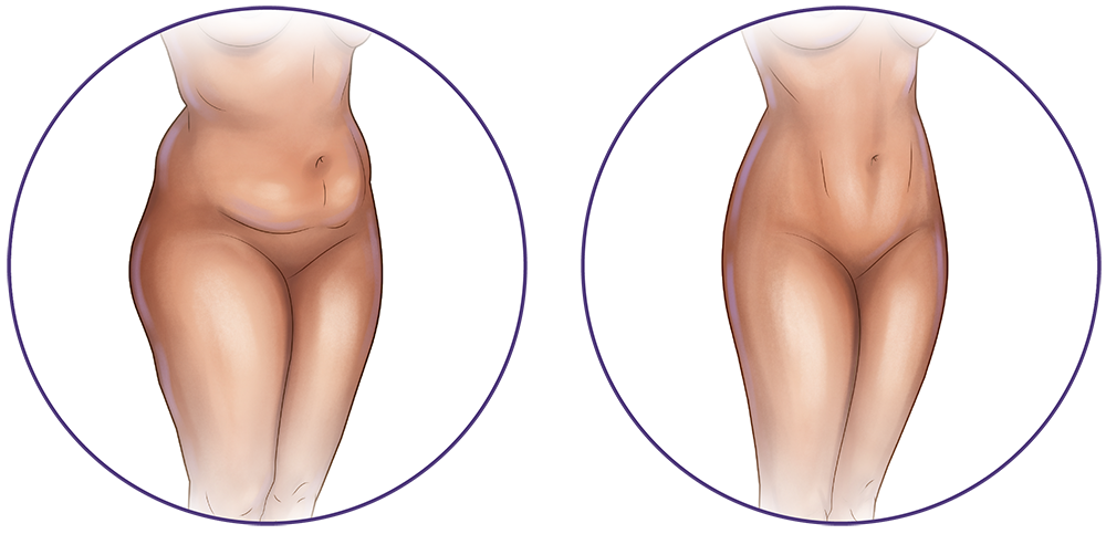 Liposuction Surgery in Montreal