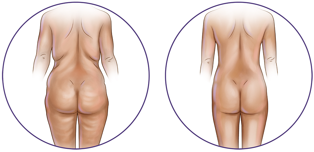 Liposuction Surgery in Montreal