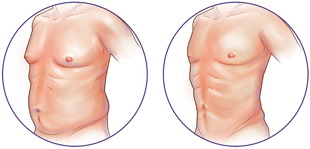 Liposuction Surgery in Montreal