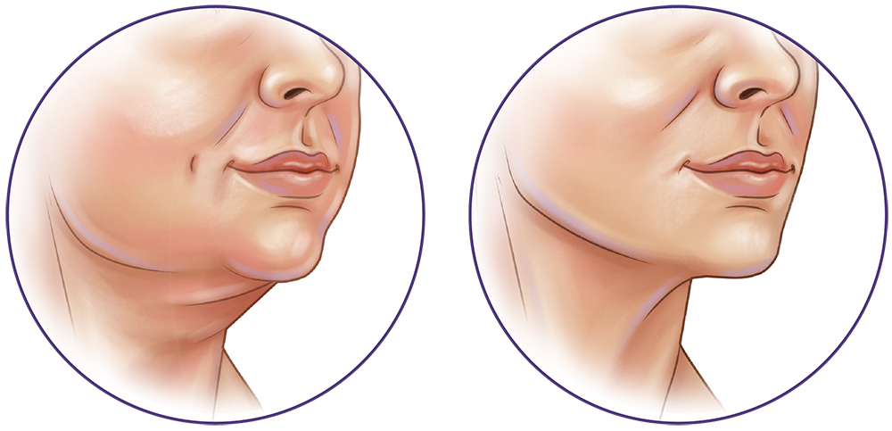 Liposuction Surgery in Montreal