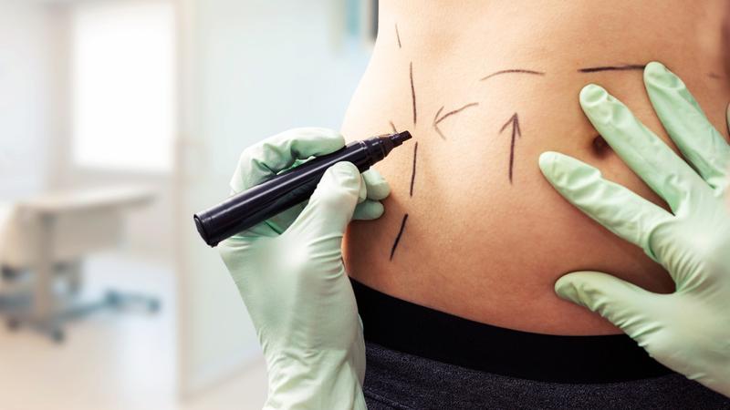 Liposuction Surgeryin Montreal